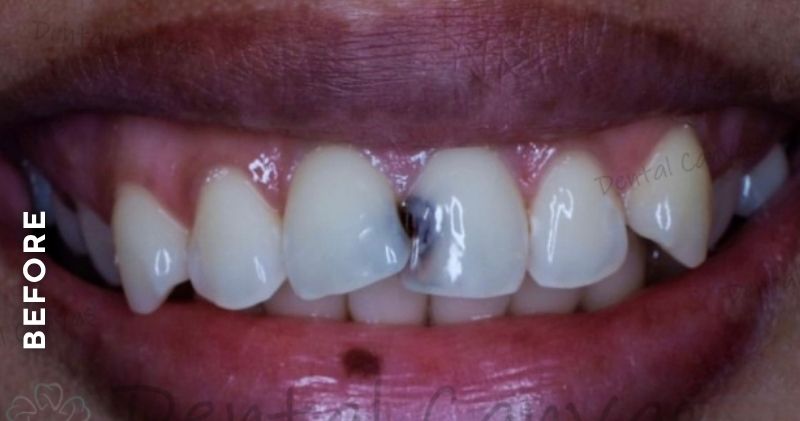 Anterior-Cavity-filling-before