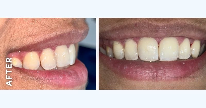 Front-Tooth-Cavity-filling-after