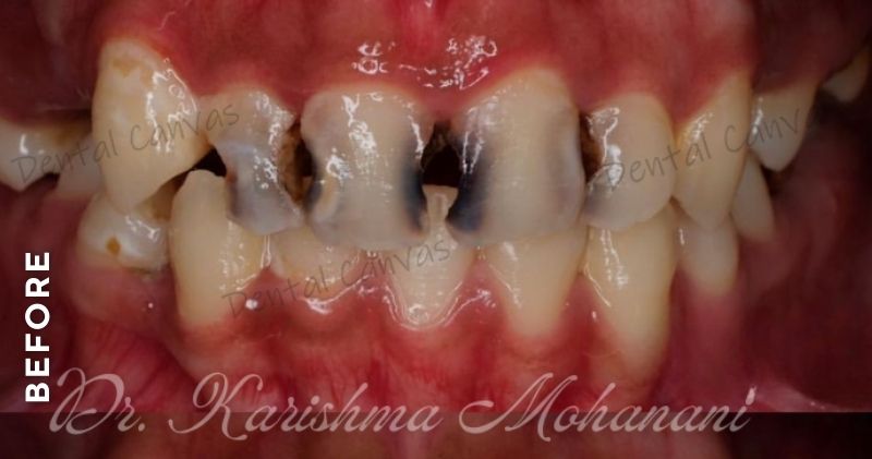 ant-composite-before