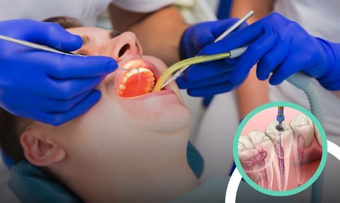 Root Canal Treatment In Marathahalli Bangalore